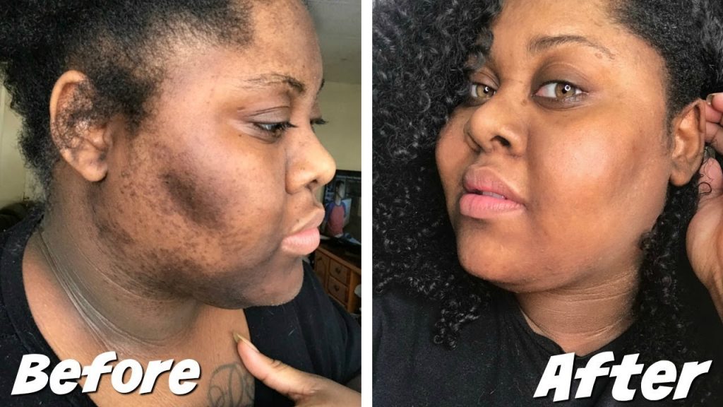 Skin lightening in Pietermaritzburg