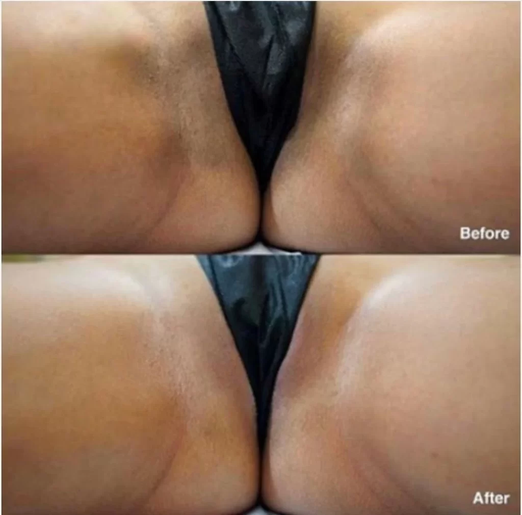 Vaginal Bleaching Cream