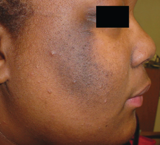 hyperpigmentation