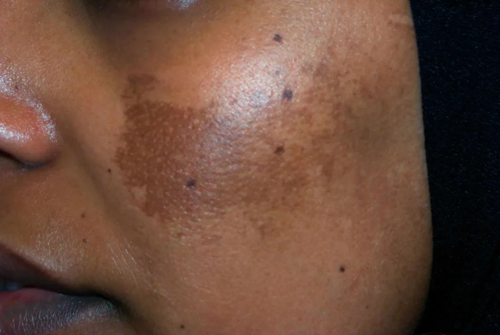 hyperpigmentation