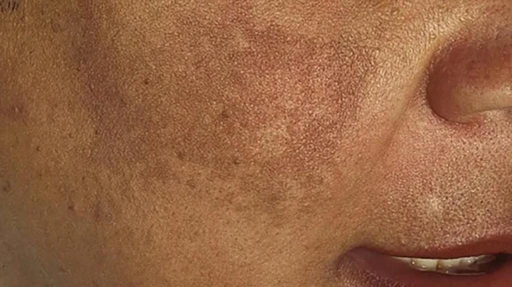 hyperpigmentation