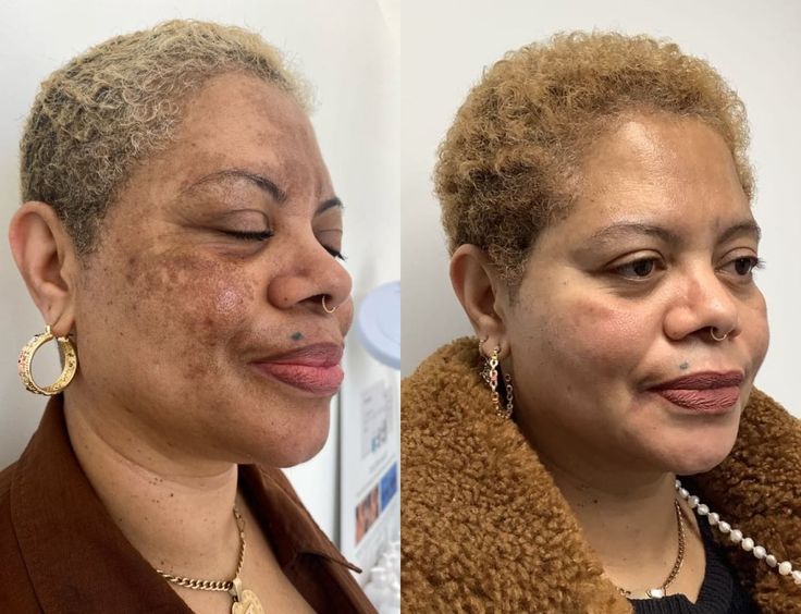  hyperpigmentation treatment south africa