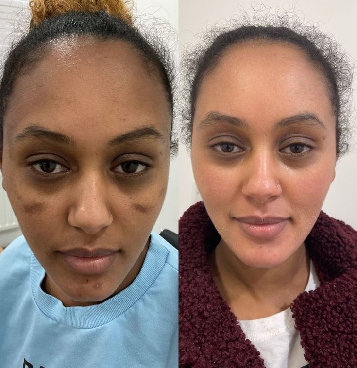  hyperpigmentation treatment south africa