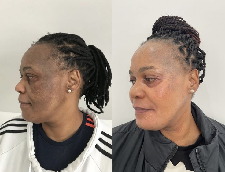  hyperpigmentation treatment south africa